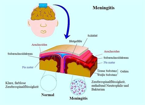 was ist meningitis krankheit